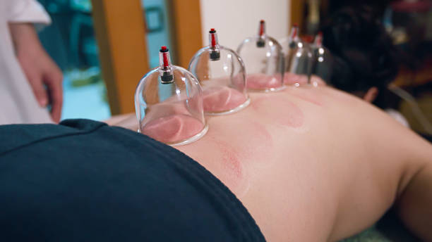 Cupping therapy applied to a patient's back